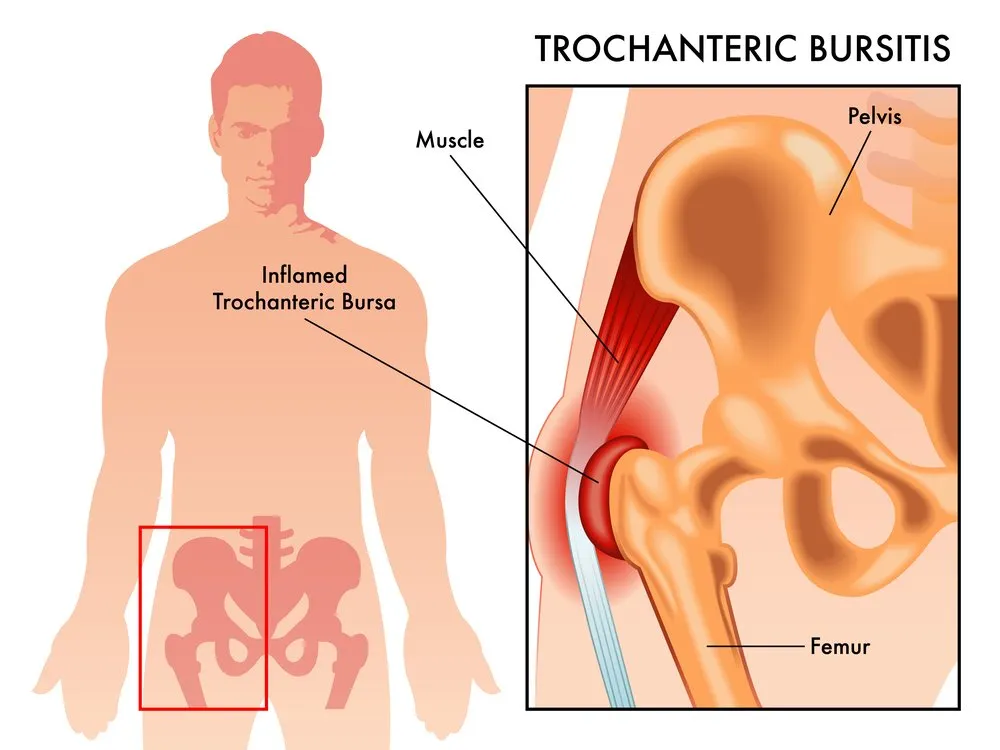 hip bursitis in runners